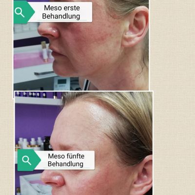 Eleganz Kosmetik Mesotherapie Behandlungsstufen
